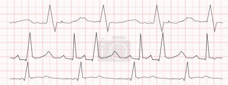 Photo for Set of black heartbeat diagrams on red graph paper. ECG electrocardiogram chart. Cardiac rhythm line. Cardio test signs. Vector graphic illustration. - Royalty Free Image