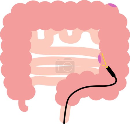 Illustration for Clip art of colon polyp Clip art of internal organs digestive organs examination - Royalty Free Image