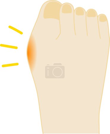 Ilustración de Doloroso dedo gordo del pie / ilustración del pie - Imagen libre de derechos