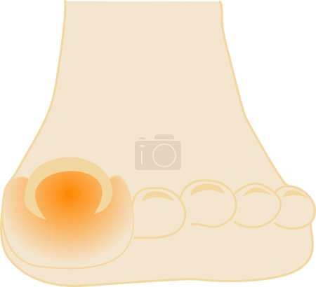 Illustration for Ingrown toenail - Illustration of foot - Royalty Free Image