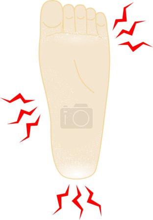 Illustration for Itchy athlete's foot / Illustration of foot - Royalty Free Image