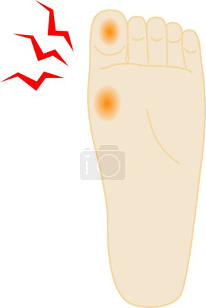 Téléchargez les illustrations : Callosité douloureuse / Illustration du pied - en licence libre de droit
