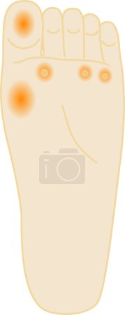 Illustration for Fish eyes and callus - Illustration of foot - Royalty Free Image