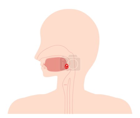 Illustration for Tonsillitis / Inflamed and painful / Illustration - Royalty Free Image