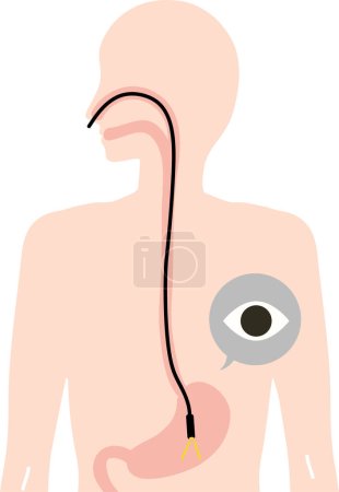 Illustration der Gastroskopie-Untersuchung