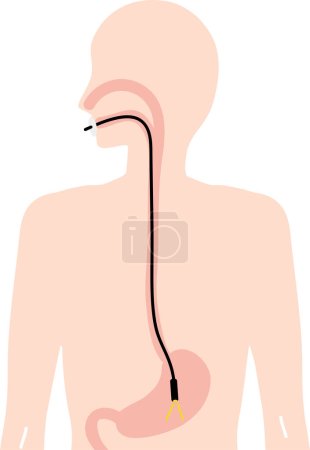 Illustration der Gastroskopie-Untersuchung