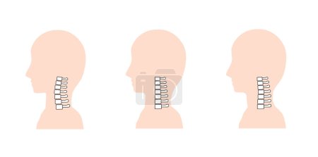Ilustración de Imagen de cuello recto, cifosis cervical y huesos normales del cuello - Imagen libre de derechos