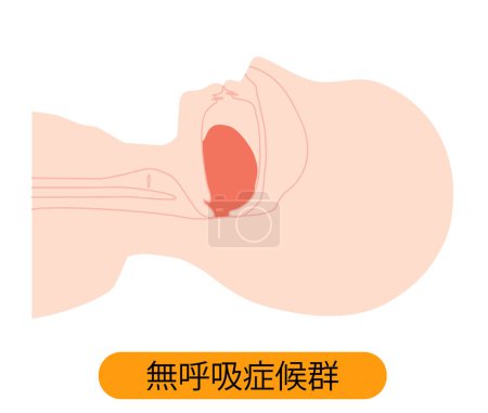 Illustration for Sleep apnea/ Illustration of tongue dropping - Royalty Free Image