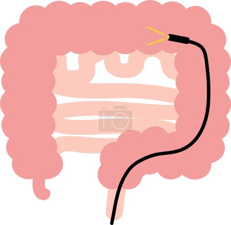 Illustration depicting a scope-type colonoscopy