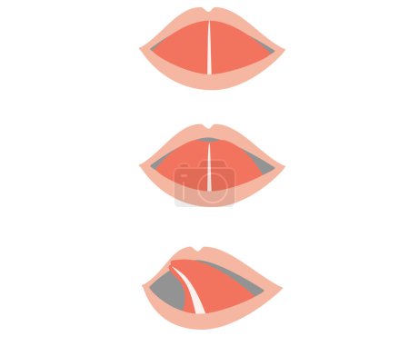 Ilustración de Ilustración de una lengua en forma de corazón cuando se extiende debido al acortamiento velofaríngeo. - Imagen libre de derechos
