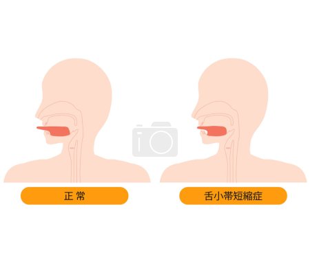 Ilustración de Ilustración de lengua y lengua normales que no se pueden extender debido al acortamiento velofaríngeo - Imagen libre de derechos