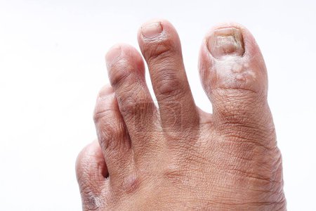 Téléchargez les photos : Plan rapproché d'un pied humain avec un clou - en image libre de droit