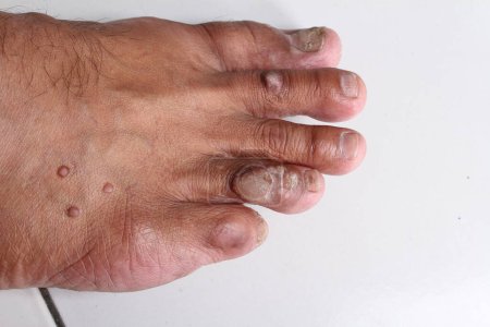 Téléchargez les photos : La peau des pieds avec une dermatose - en image libre de droit
