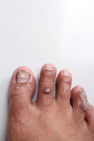 Photo for A man 's foot is covered with the fungus - Royalty Free Image