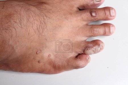 Foto de Primer plano de los pies de un hombre con la piel rota. - Imagen libre de derechos