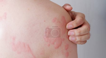 Close up image of skin texture suffering severe urticaria or hives or kaligata on back. Allergy symptoms.