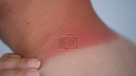 Téléchargez les photos : Rougeur sur le cou de l'homme des coups de soleil, vue rapprochée - en image libre de droit