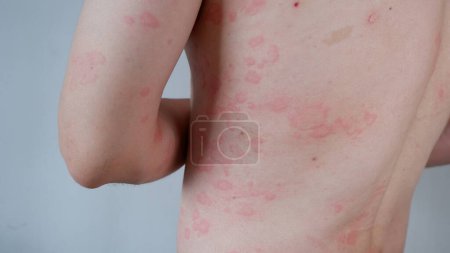 Téléchargez les photos : Close up image of skin texture suffering severe urticaria or hives. Allergy symptoms. - en image libre de droit