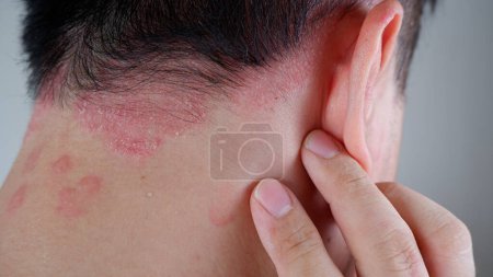 Photo for Close-up view of psoriasis on the man nape, skin with psoriasis - Royalty Free Image