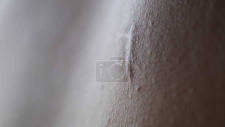 Photo for Keloid, also known as keloid disorder and keloidal scar. It is a result of an overgrowth of granulation tissue. - Royalty Free Image