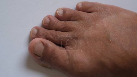 Téléchargez les photos : Signes initiaux de déformation du pied d'oignon du tailleur - en image libre de droit