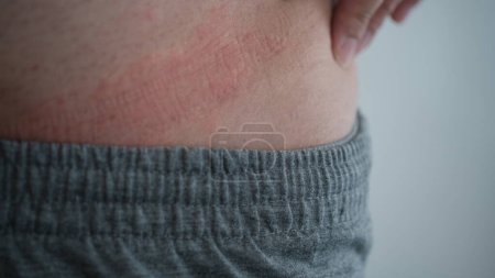 Photo for Close up image of skin texture suffering severe urticaria or hives or kaligata on back. - Royalty Free Image