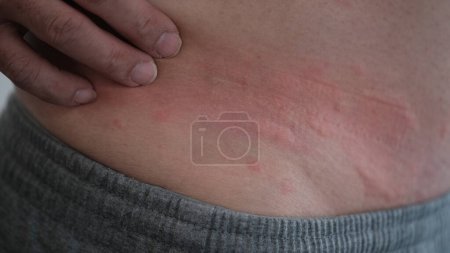 Photo for Close up image of skin texture suffering severe urticaria or hives or kaligata on back. - Royalty Free Image
