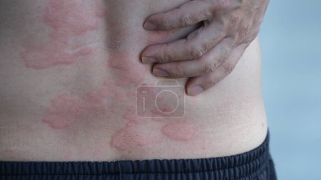 Imagen de cerca de la textura de la piel que sufre urticaria severa o urticaria o caligata en la espalda