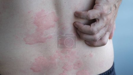 Imagen de cerca de la textura de la piel que sufre urticaria severa o urticaria o caligata en la espalda