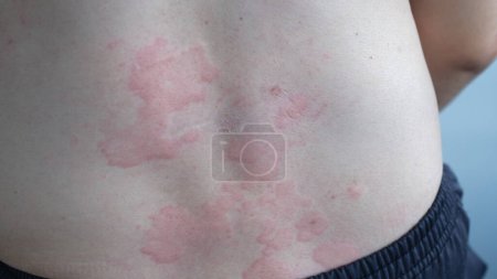 Close up image of skin texture suffering severe urticaria or hives or kaligata on back