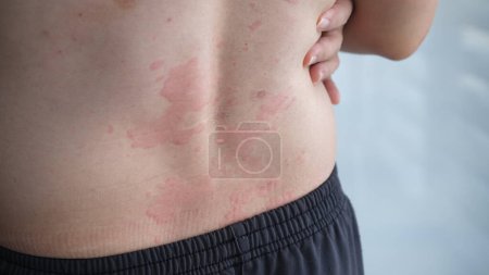 Photo for Close up image of skin texture suffering severe urticaria or hives or kaligata on back - Royalty Free Image