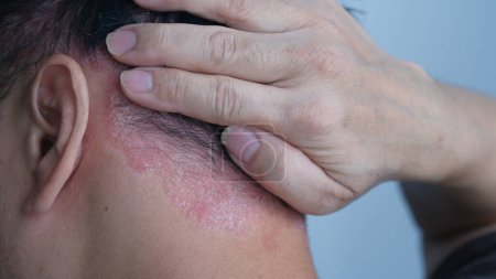 psoriasis on the nape of a man. skin with psoriasis.
