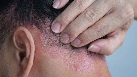 Téléchargez les photos : Psoriasis sur la nuque d'un homme. peau avec psoriasis. - en image libre de droit