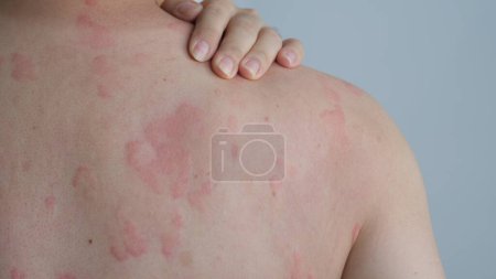 Nahaufnahme der Hautstruktur, die unter schwerer Urtikaria oder Nesselsucht oder Kaligata auf dem Rücken leidet. Allergische Symptome.