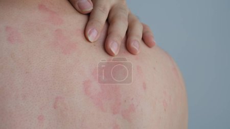 Téléchargez les photos : Image rapprochée de la texture de la peau souffrant d'urticaire sévère ou d'urticaire ou de kaligata sur le dos. Symptômes allergiques. - en image libre de droit