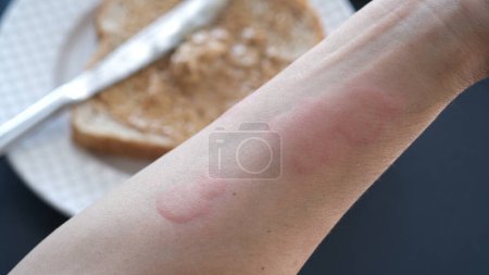 Close up image of arm suffering severe urticaria or hives or kaligata with illustration of allergy trigger foods.  Peanut butter.