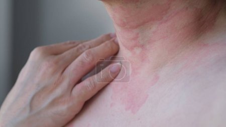 Image rapprochée de la texture de la peau souffrant d'urticaire sévère ou d'urticaire ou de kaligata sur le cou. Symptômes allergiques.