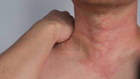 Imagen de cerca de la textura de la piel que sufre urticaria severa o urticaria o caligata en el cuello. Síntomas alérgicos.