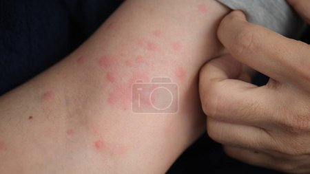 Close up image of arm suffering severe urticaria or hives or kaligata.