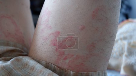 Image rapprochée de la texture de la peau souffrant d'urticaire sévère ou d'urticaire ou de kaligata sur les cuisses d'un homme. Symptômes allergiques.