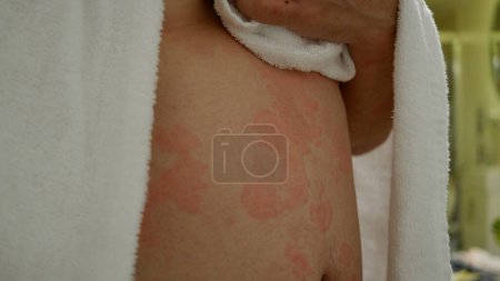 Image rapprochée de la texture de la peau souffrant d'urticaire sévère ou d'urticaire ou de kaligata sur un corps humain. Symptômes allergiques.