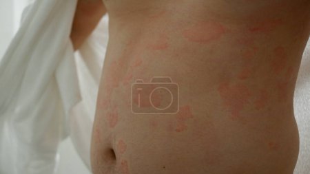 Nahaufnahme der Hautstruktur, die unter schwerer Urtikaria oder Nesselsucht oder Kaligata am Körper des Mannes leidet. Allergische Symptome.