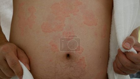 Nahaufnahme der Hautstruktur, die unter schwerer Urtikaria oder Nesselsucht oder Kaligata am Körper des Mannes leidet. Allergische Symptome.
