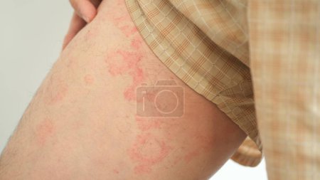 Nahaufnahme der Hautstruktur, die unter schwerer Urtikaria oder Nesselsucht oder Kaligata an den Schenkeln eines Mannes leidet. Allergische Symptome.