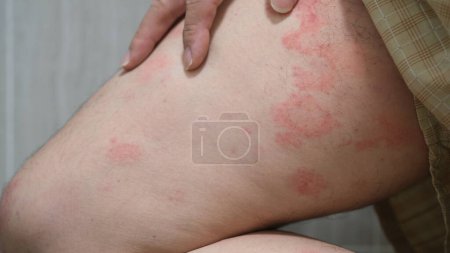 Imagen cercana de la textura de la piel que sufre urticaria severa o urticaria o kaligata en los muslos de un hombre. Síntomas alérgicos.