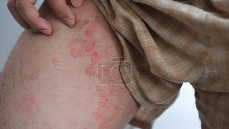Nahaufnahme der Hautstruktur, die unter schwerer Urtikaria oder Nesselsucht oder Kaligata an den Schenkeln eines Mannes leidet. Allergische Symptome.