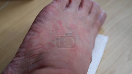 Image rapprochée de la texture de la peau souffrant d'urticaire sévère ou d'urticaire à pied. Symptômes allergiques.