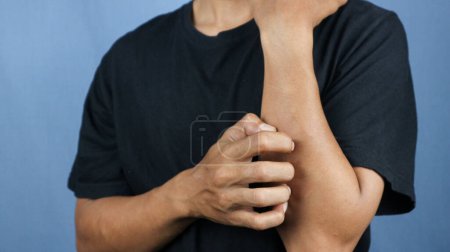Joven asiático rascándose la mano aislado sobre fondo azul. Concepto de enfermedades de la piel con picor como sarna, infección fúngica, eczema, psoriasis, erupción cutánea, alergia, etc..
