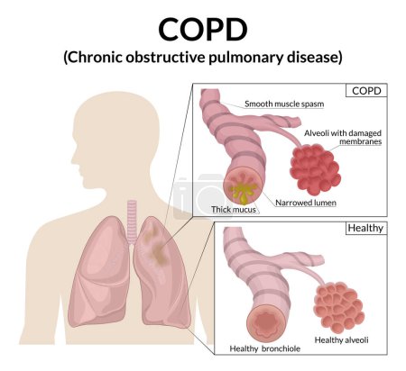 La ilustración muestra una sección de bronquiolos y alvéolos en una forma normal y aquellos afectados por la enfermedad pulmonar obstructiva crónica.