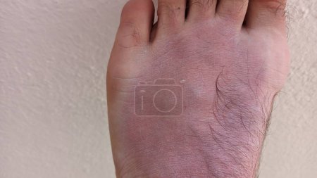 Téléchargez les photos : Robuste bronzage sur pied de jambe peau très rouge brûlé au Portugal en photo d'été - en image libre de droit